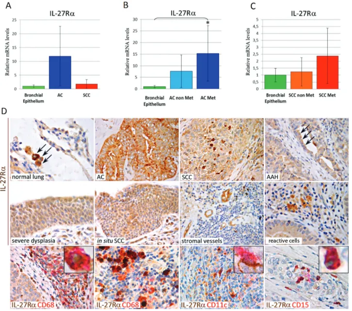 Figure 5: mRNA and Protein Expression of IL-27Rα in Human Normal Lung, Pre-Neoplastic Lesions, Lung AC and  SCC