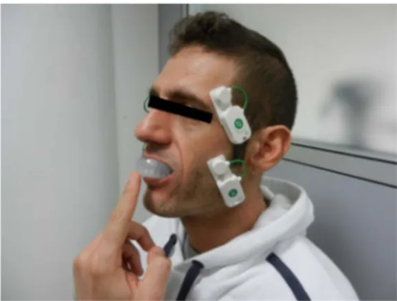 Figure 1.   The athlete during electromyography analysis with mouthguard: the surface  electrodes were positioned parallel to the muscle fibres of masseters and temporalis