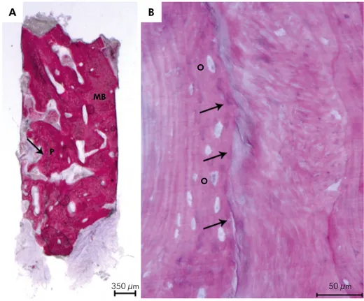 Figure 3. Group 1: inflammation and multinucleated giant cells  were absent around the newly formed bone (NB) surrounding  autologous bone particles (*)