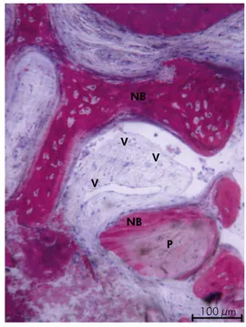 Figure 5. Group 2: in a marrow space a rim of osteoblasts  (Ob) deposing new bone directly on the porcine bone granule  surface was evident