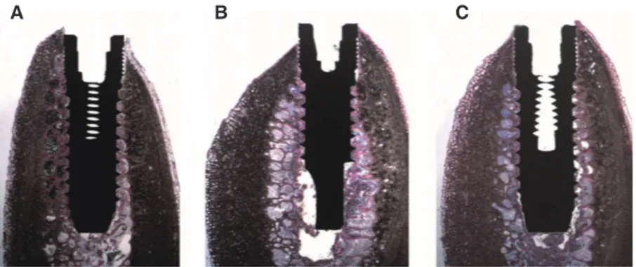Fig. 4.  Low power, histological image of the retrieved specimens belonging to (A) Underprepared site: bone tissue and  bone chips surrounding almost the whole implant surface could be observed; only in the portions where the spongy  bone was present, and 
