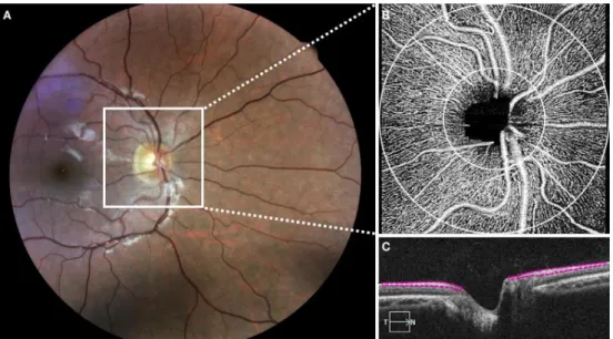 Figure 1. (A) Optic nerve head (ONH) and radial peripapillary capillary (RPC) perfusion assessment 