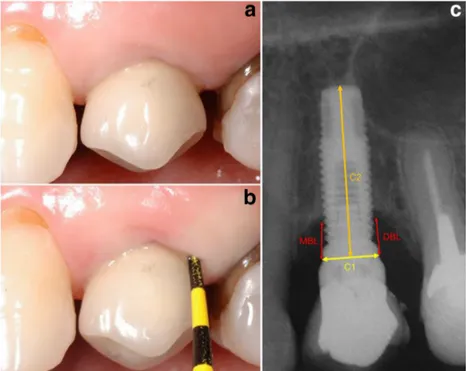 Fig. 1 a Clinical view of an implant-supported single crown (ISSC). b Probing depth  mea-sured around an  implant-supported single crown (ISSC)