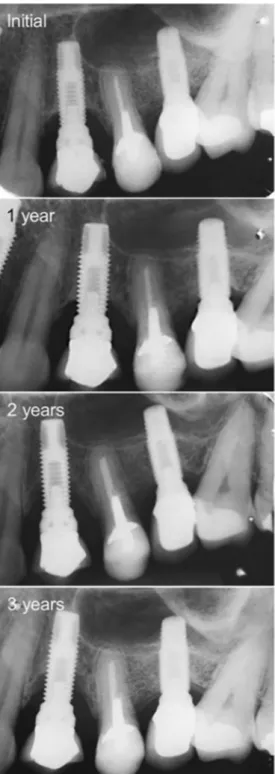 Fig. 2 Radiographic images of two implant-supported single crowns (ISSC) at the 3-year follow-up