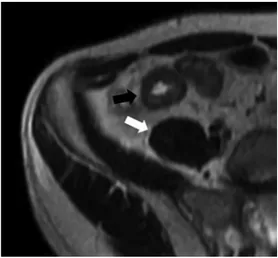 Fig. 1. Axial T2-weighted image shows hyperintense  mural thickening of the last ileal loop with  hyperintense signal (black arrow) compared with  skeletal muscle (white arrow).