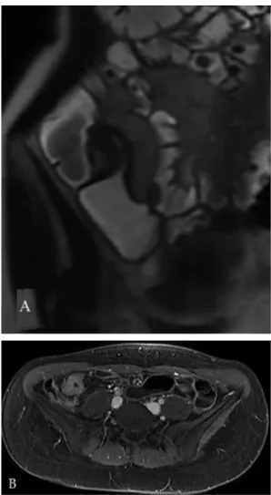Fig. 2. Pattern of active inflammation. A: Axial T1- T1-weighted image after i.v. injection of contrast medium  shows mural thickening of the distal ileum with target  sign (white arrow); B: Endoscopy shows multiple  aphthous ulcers.