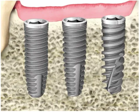 Figure 2. Graphical representation of the IC, IK, and IA implants. 