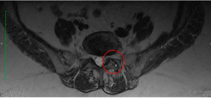Figure 2 MR after 6 months (T4). Image of the lumbar spine in T2 sequences; red circle highlights the L5-S1 facet joint with evidence of osteoarthritis without effusion.