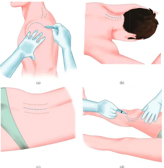 Figure 3: Some areas that can be treated: shoulder (a); cervical spine (b); lumbar spine (c); knee (d)