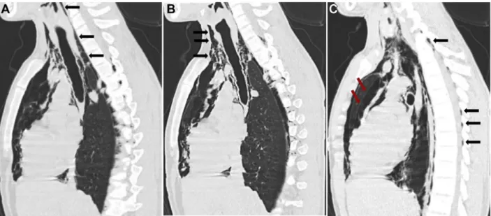 Figure 1 – Sagittal view of CT scan of the neck and mediastinum. A, Extensive soft tissue abnormality (emphysema) in the retropharynx with loss of normal fat plane with the prevertebral space and possible communication with the oropharynx (black arrows)