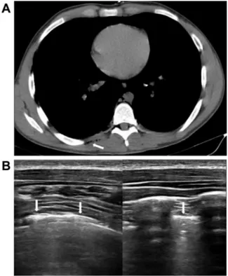 Figure 3 – The air is visible in the surrounding thyroid parenchyma on the axial view both of cervical CT imaging (white arrows) (A) and cervical ultrasound (B)