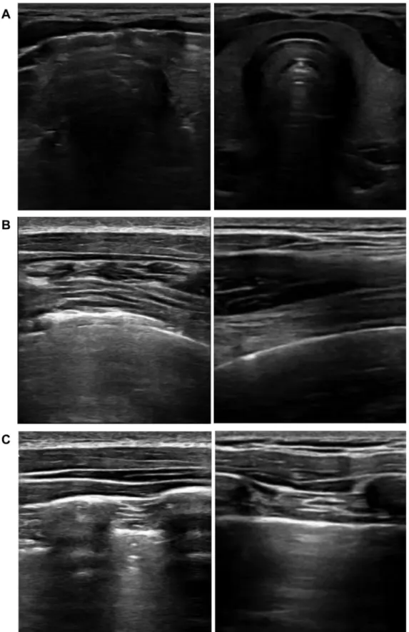 Figure 6 – A, The ultrasound of the neck on the axial view of the thyroid gland. On the left, the acoustic barrier makes visualization of the “butterﬂy image” of the thyroid difﬁcult due to the air into the soft tissues of the neck; on the right, following