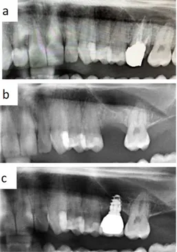Figure 2. Occurrence of severe atrophy after removal of decayed first molar with periapical lesions (a,b); single tooth prosthetic rehabilitation without conventional sinus lift is feasible with short implant use (c).Healthcare 2020, 8, x    3 of 7 Figure 