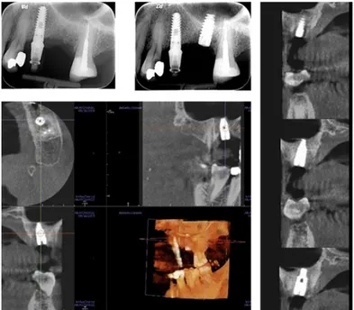 Figure 5. Radiological investigations showing the pre-surgical planning of the crestal sinus lifting and the radiological result after implant insertion; the elevation of sinus membrane is evident, and no signs of intra-sinusal inflammation are detectable 