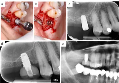 Figure 6. Intraoperative view of implant insertion by muco-periosteal flap elevation (a,b); the implant diameter is larger than implant site preparation, thus promoting bone dislocation in the apical direction by the self-tapping capability of the fixture 