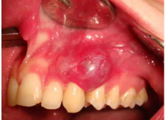 Figure 1. Soft red-violet swelling of the adherent gingiva in a 17 y.o. male patient. 