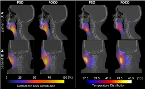 Fig. 2.2. Temperature and normalized SAR distribution related to case A on a sagittal view, and N on a coronal view obtained by means of THQ PSO optimized and FOCO.
