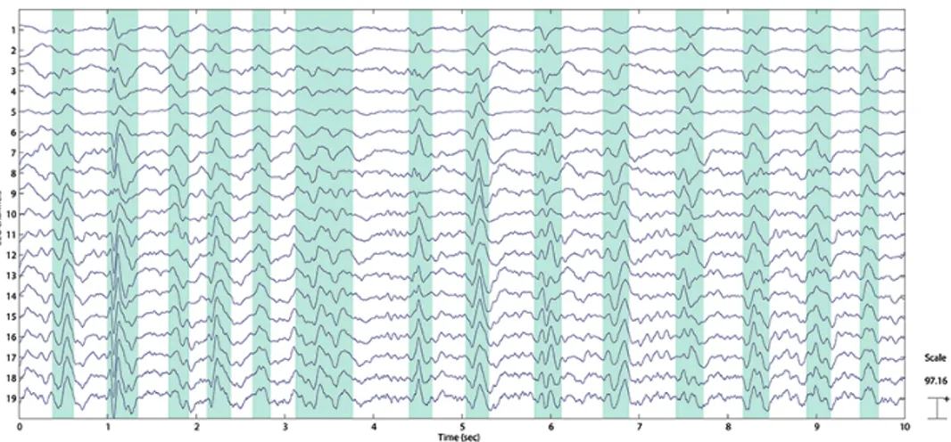 Fig. 2.1. Partitioning of an EEG into segments with PSWCs and without PSWCs - shaded segments correspond to the ones with PSWCs