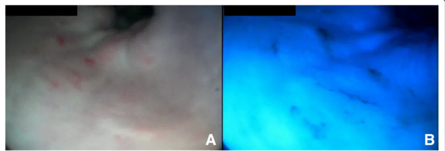 Fig. 1 Distal oesophagus and cardia. a White light endoscopy. The oesophageal mucosa proximal to the cardia appears mildly erythematosus with small superficial areas of bleeding