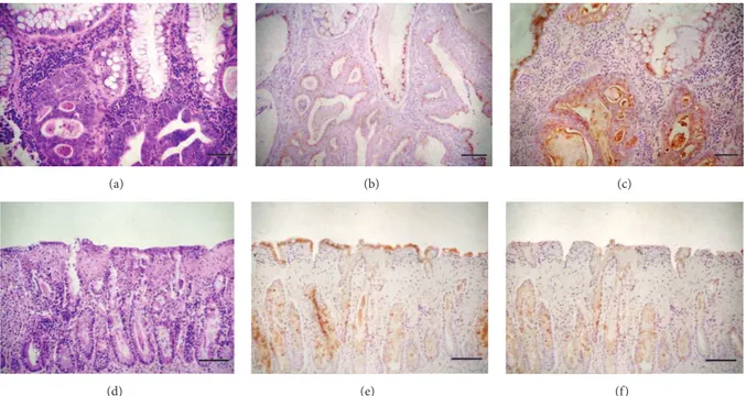 Figure 2: Expression of DAO and ODC in different colonic pathological conditions. (a) Morphological aspect of colonic carcinoma with areas of squamous metaplasia