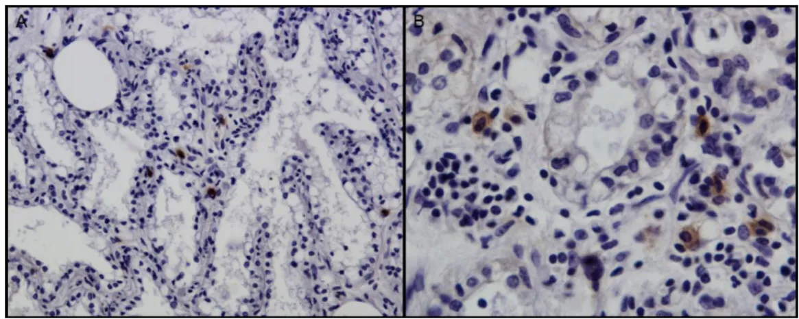 Figure  2.  IHC  against  p28  of  CAEV/VMV  in  mammary  gland.  (A)  Scattered  positive  cells  within 