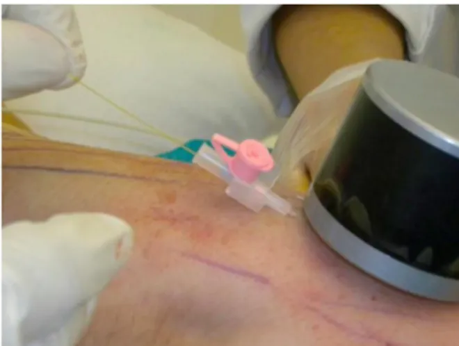 Figure 2 Introduction of a 21-gauge plastic venous catheter and subsequently of the 