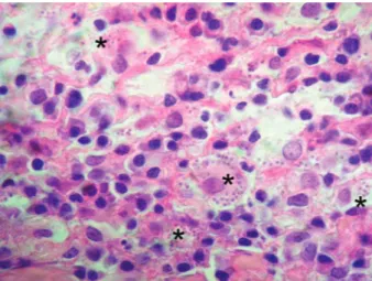 Figure 1. Skin, within the cytoplasm of a macrophage and  between inflammatory cells numerous 2–4 µm, ovoid,  protozoan amastigotes are visible (× 100 magnification)