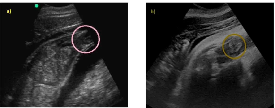 Figure 9. (a) An ultrasound image of female genitals (apricot-shaped) by SonoSite 180 Plus with a 2–