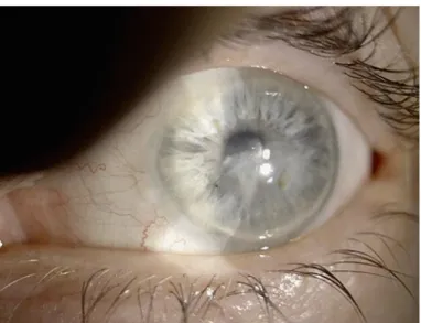 Fig. 12.  Same eye of Figure 11 after 10 days of therapy. Resolution of corneal ulcer with negative staining