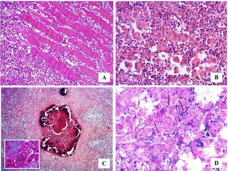 Figure 2. Histological examination:  A) widespread inflammatory infiltrate invading the  endomysium (HE, 10× magnification); B) mixed inflammatory infiltrate constituted by granulocytes  neutrophils and eosinophils, macrophages, lymphocytes, plasma cells, 