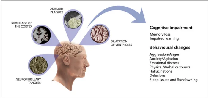 Fig. 2. Schematic representation of cerebral modifications in Alzheimer’s disease. AD is characterized by loss of neurons in the hippocampus and cerebral cortex, shrinkage of the cortex, enlargement of ventricles, resulting in the progressive decline in co