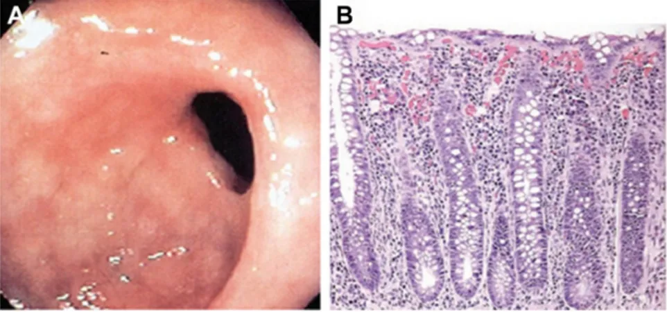 Figure 3 Sample endoscopic and microscopic views of gastrointestinal tract mucosae damaged by NSAIDs.