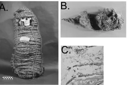 Fig 1. Pre-Columbian Andean mummy in this study (Panel A), distended colon with paleofeces (Panel B), and Trypanosoma cruzi amastigotes (Panel C).
