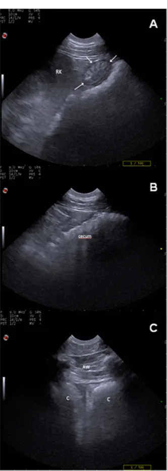 Figure 1. (A) ultrasonographic visualization of the descending duodenum (arrows). RK: right kidney