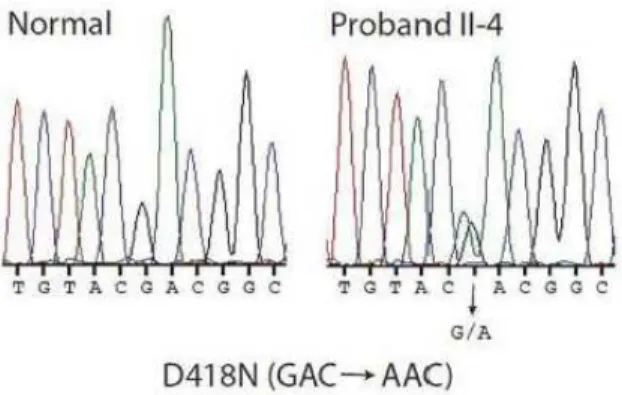 Figure  6b.  Detection  of  a  mutation  in  the  MEN1  gene.  Direct  sequence  analysis  of  the  exon  9  genomic DNA amplicon of proband II-4 (right) revealed a heterozygous G to A transition encoding  the missense D418N mutation compared with an unrel