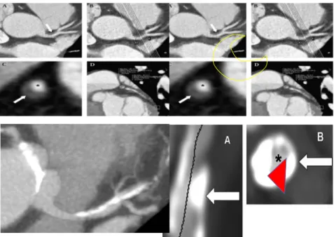 Figure 4. Atherosclerosis of the coronary arteries 