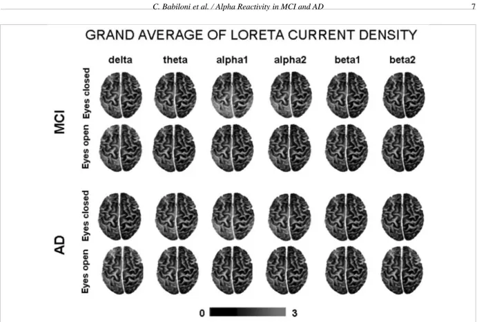 Fig. 1. Grand average of the LORETA solutions (i.e., relative power current density at cortical voxels) modeling the distributed EEG cortical sources at delta, theta, alpha 1, alpha 2, beta 1, and beta 2 bands in MCI and AD subjects for the two conditions,