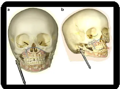 Figure 8. Schematic drawings of the application of two distracters on the maxilla and  mandible in HFM show application of the maxillary and mandibular distractors after  performing the Le Fort I osteotomy and the horizontal osteotomy of the mandibular ram