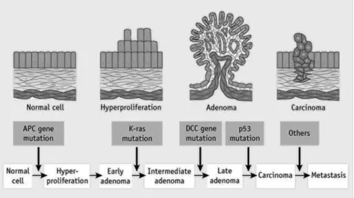 Figure 1. The genetic model of colorectal tumorigenesis. Colorectal cancers develop over the course 