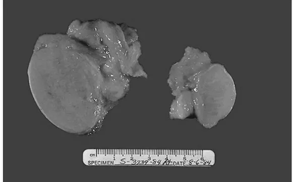 Fig. 8: Comparison between a normal testis (on the left) and an atrophic testis  (on  the  right)  after  exposition  to  AASs  chronic  abuse