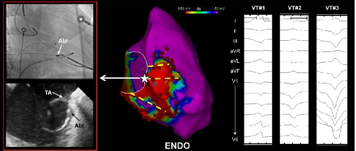 Figure 1. Typical distribution of endocardial (ENDO) ablation lesions across abnormal right 
