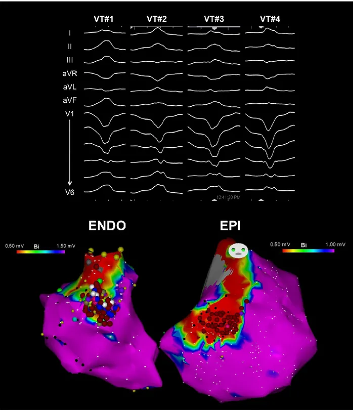 Figure 2. Example of endo-epicardial (ENDO-EPI) substrate ablation set in a patient with 