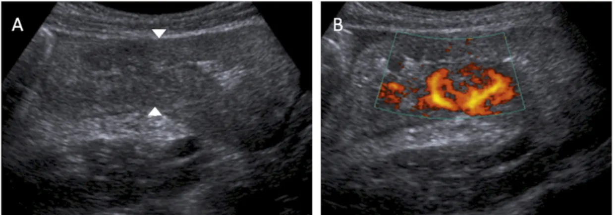 Figure 3. US study identifying thickened ileo-caecum of acute Crohn’s with small bowel obstruction