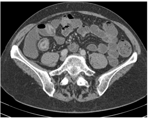 Figure 4. Axial CT enteroclysis demonstrating the ‘target sign’; three concentric layers of bowel wall 