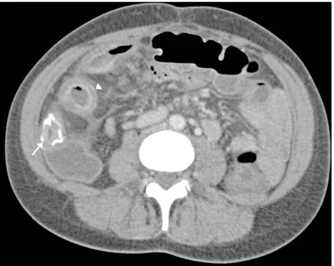 Figure 5. Axial CT enteroclysis (imaged prone). Disease recurrence with thickening of the neo-