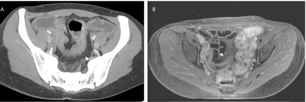 Figure 7.  ‘Comb sign’  (arrowheads) as demonstrated on CT (A) and MRI (A). Axial enhanced 