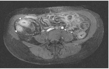 Figure 9. Axial MRI T1 post IV Gadolinium demonstrating the ‘target sign’ (arrowheads) as seen on 