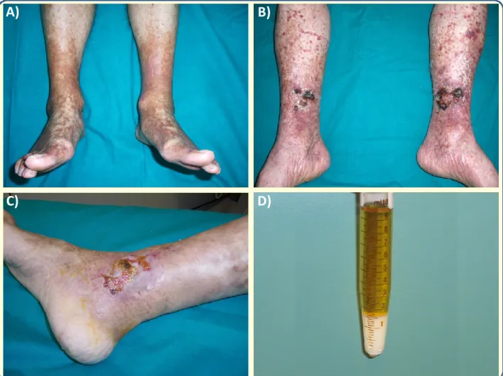 Figure 2. Clinical manifestations of cryoglobulinemic vasculitis.  A) purpuric manifestations of the legs; B) and C) 