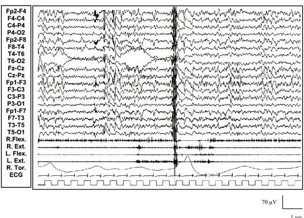 Figura 6: Paziente 1 (in alto): comparsa in veglia di anomalie a tipo brevi treni di  polipunta rapida diffusa associati a potenziali muscolari fasici a tipo mioclono