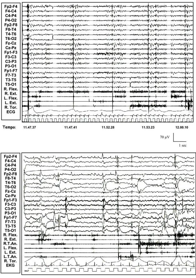 Figura 7: Paziente 1 (in alto): ripetitive anomalie epilettiformi, evocate dal risveglio  e  dopo  un  episodio  tonico-clonico  apparentemente  generalizzato,  correlate  a  potenziali  muscolari  fasici  a  tipo  mioclono